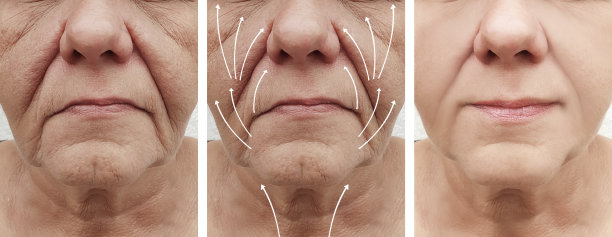 wrinkles