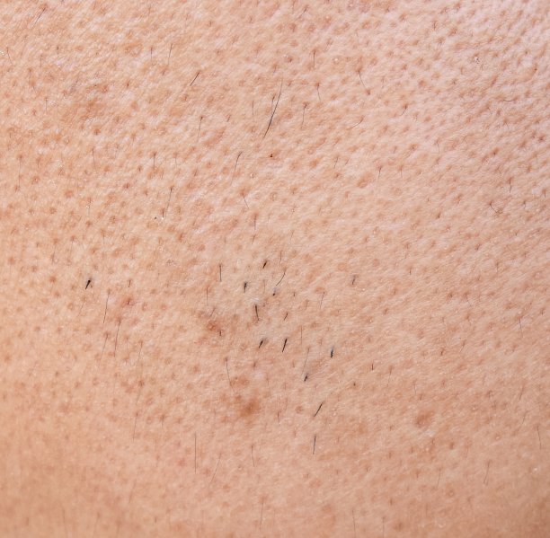pores