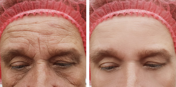 wrinkles