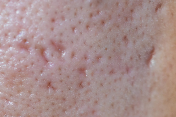 pores