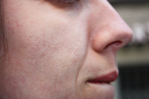 pores