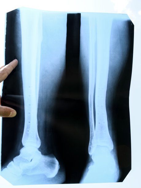 tibia