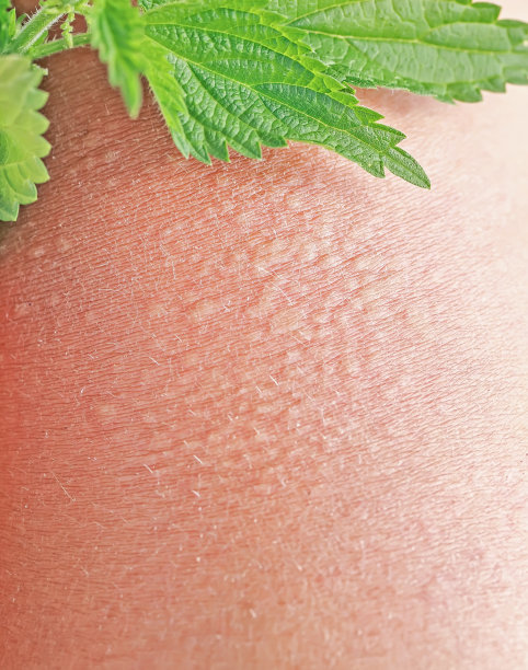nettles