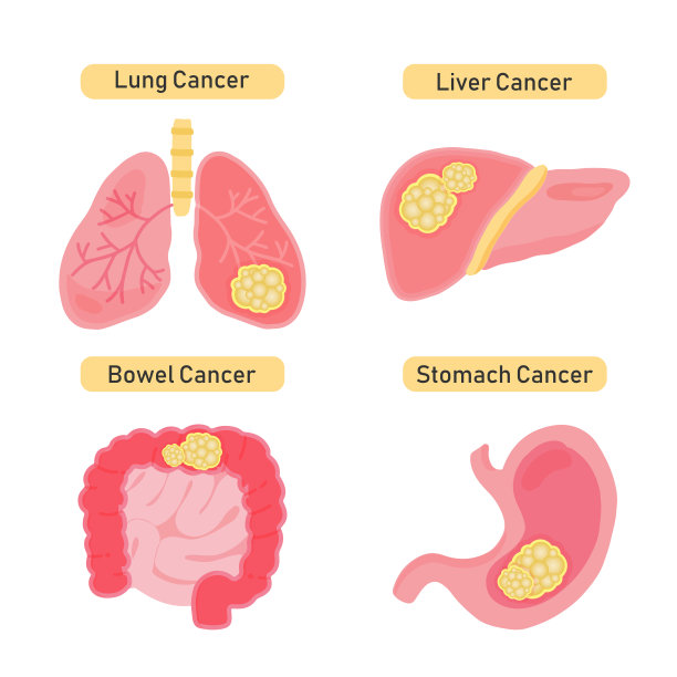 cancer