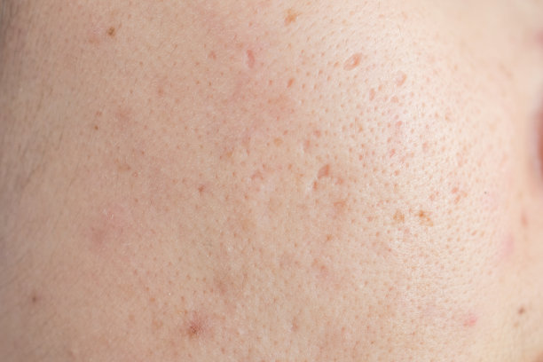 pores