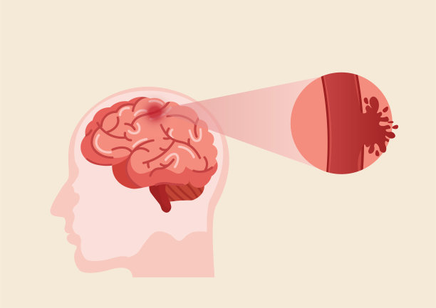 stroke