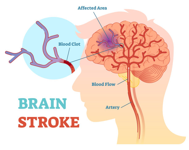 stroke