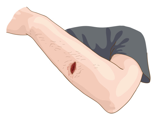 cuts