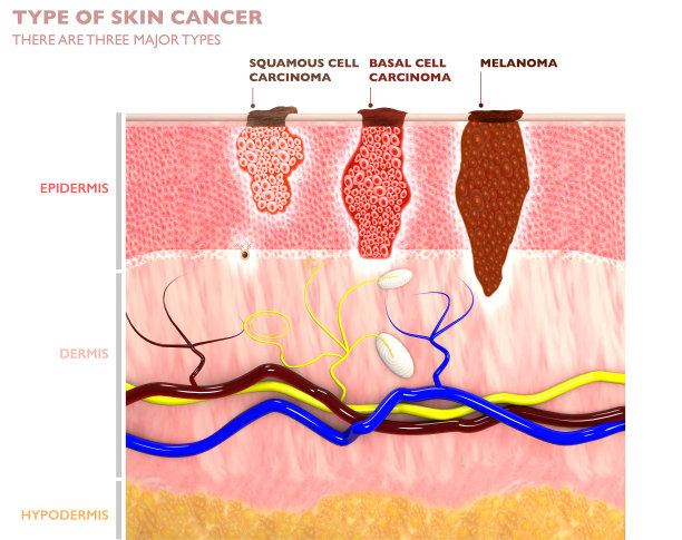 基皮细胞癌