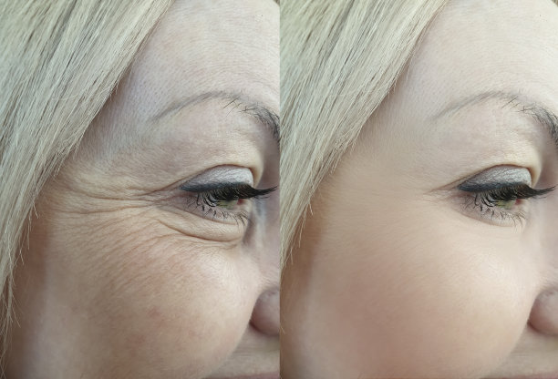 wrinkles