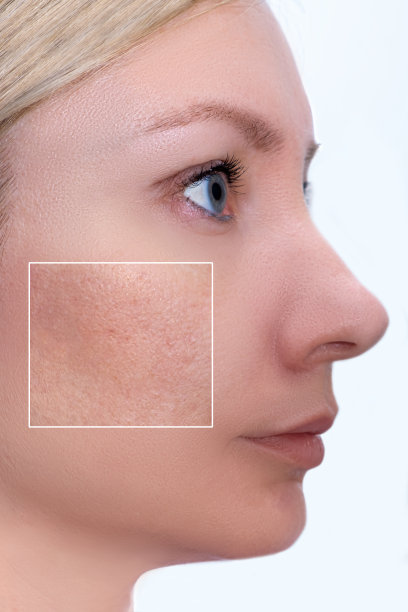 pores