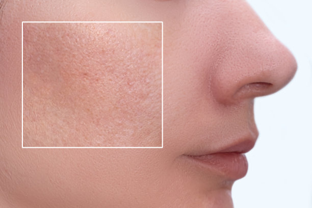 pores