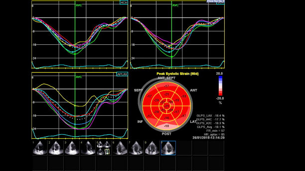 ecg