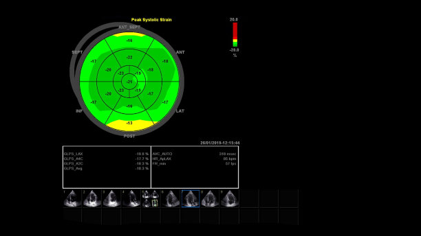 ecg