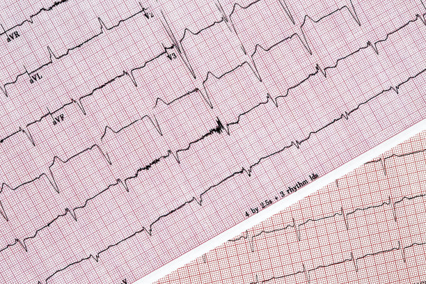 ecg