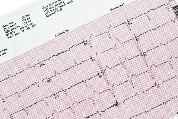 ekg