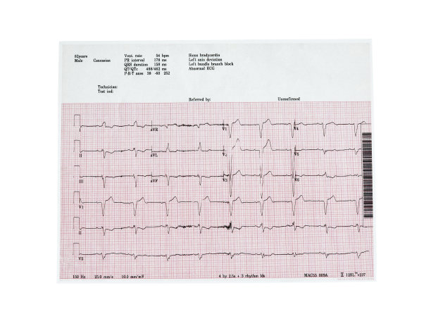 ekg