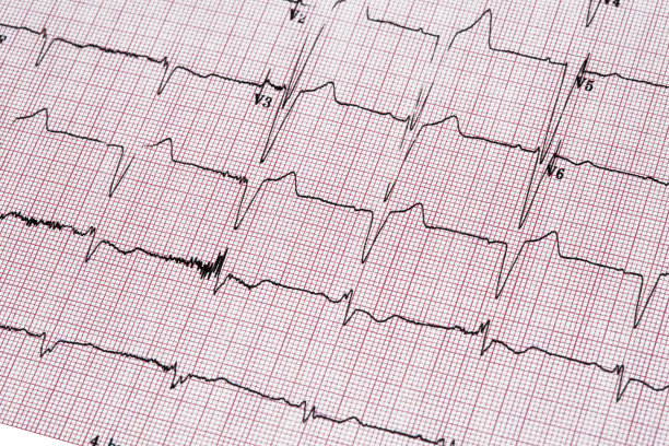 ecg