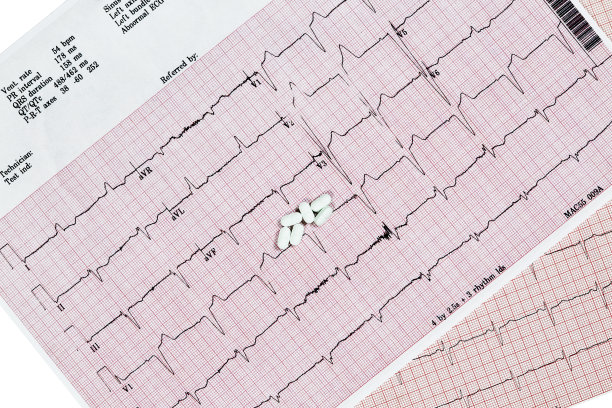 ecg