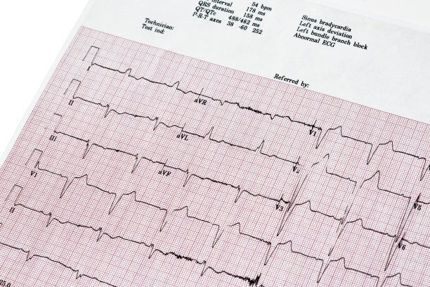 ekg
