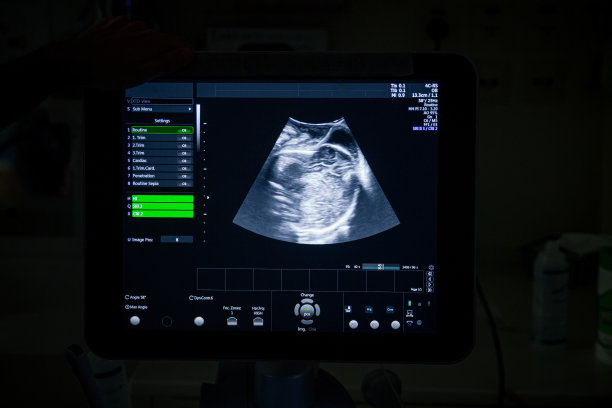ekg