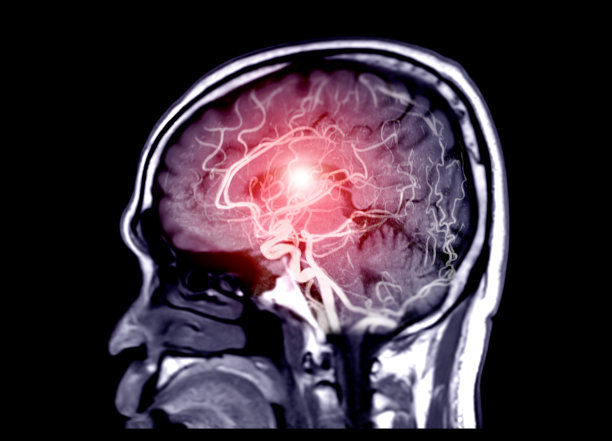 stroke