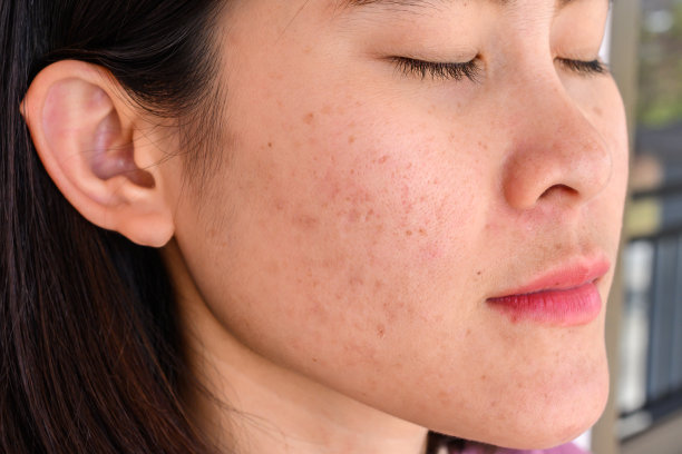 pores