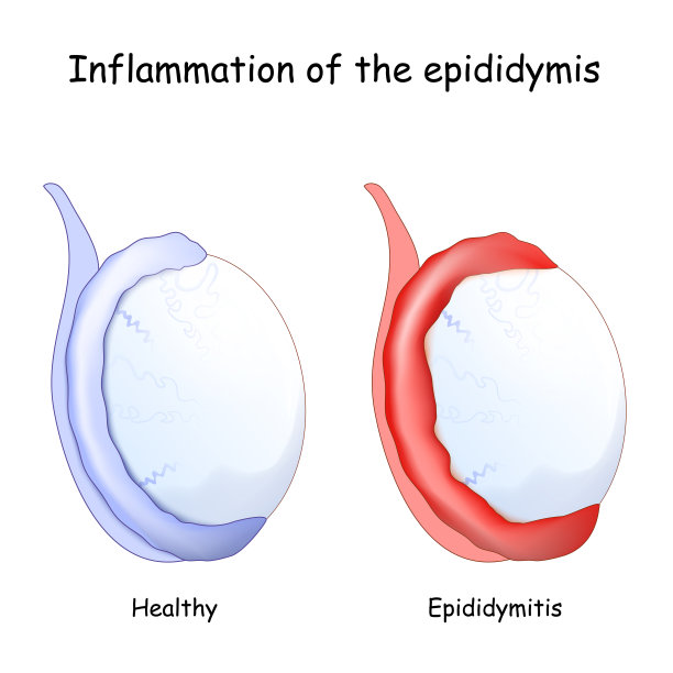 inflammation