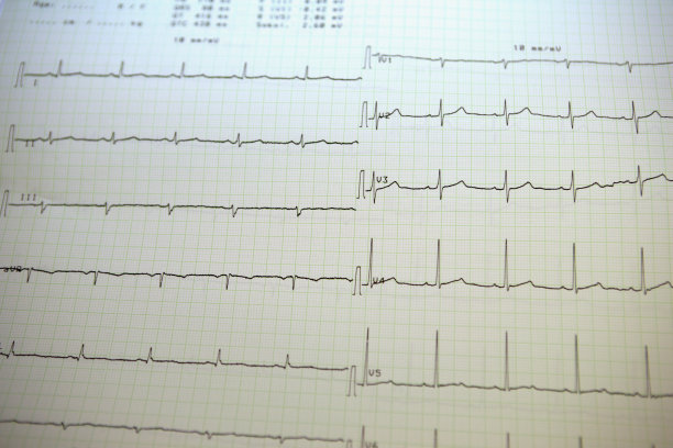 ekg
