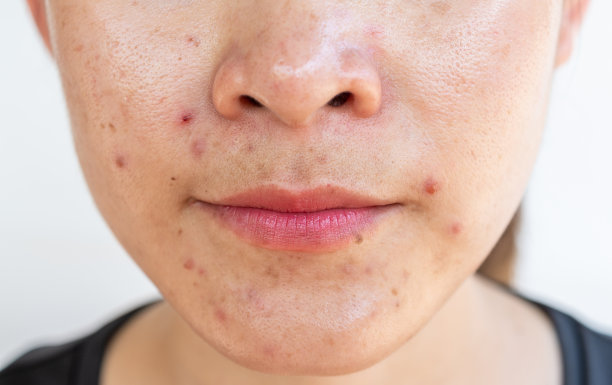 pores