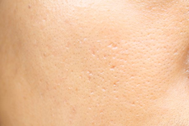 pores
