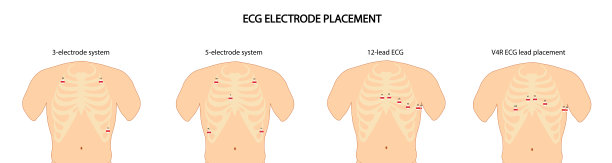 ekg