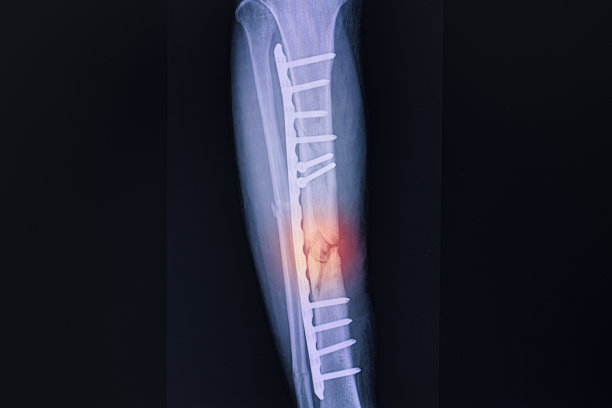 tibia