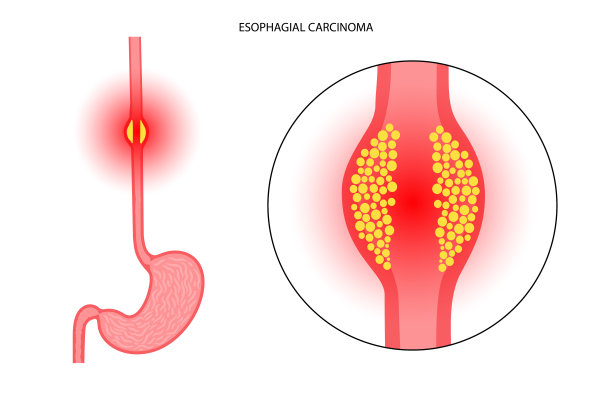 inflammation