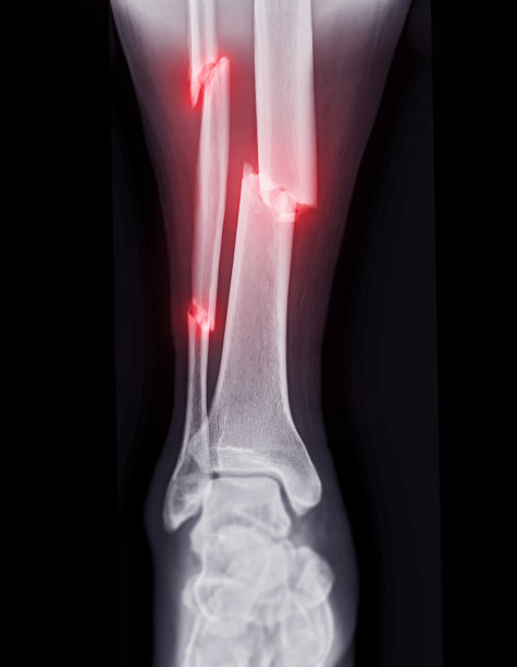 tibia