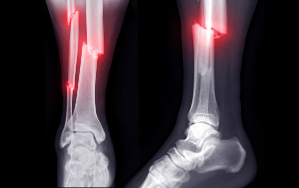 tibia