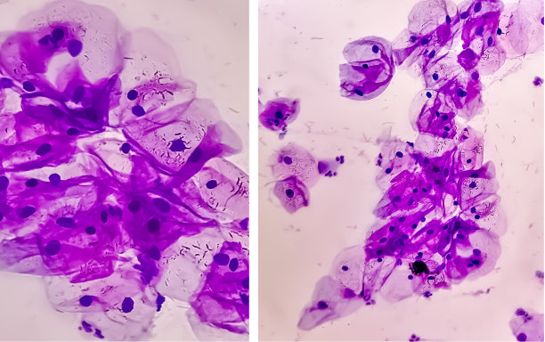 hpv