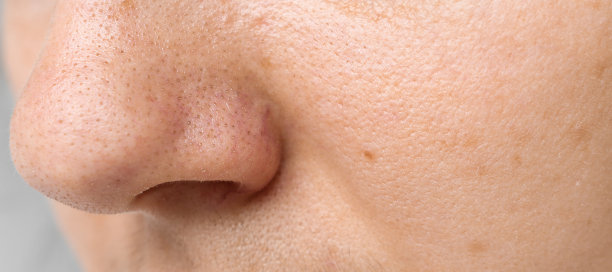 pores
