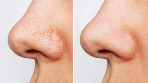 nose