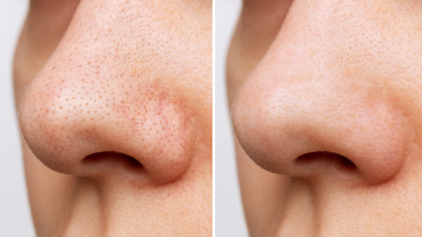 nose