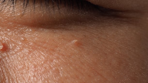 hpv