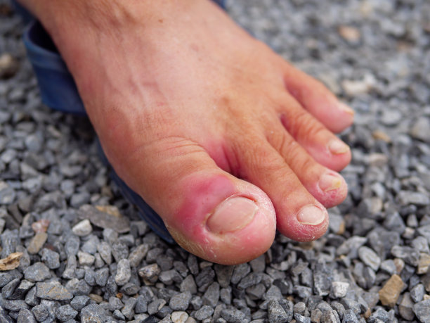 inflammation
