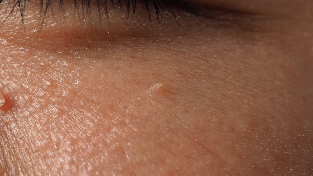 hpv