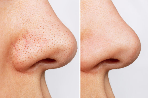 nose