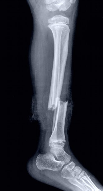 tibia