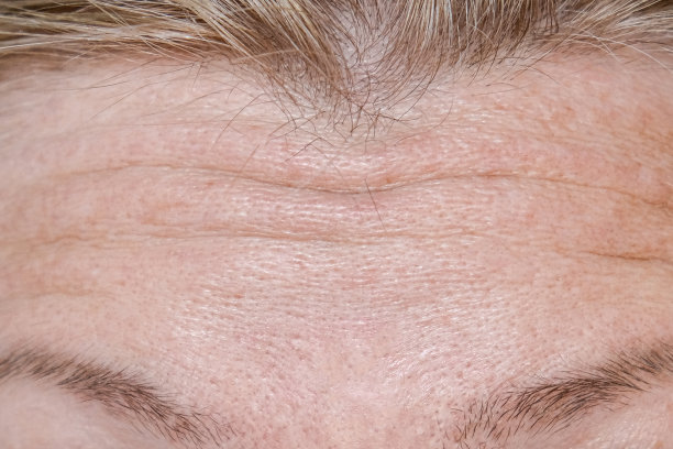 wrinkles