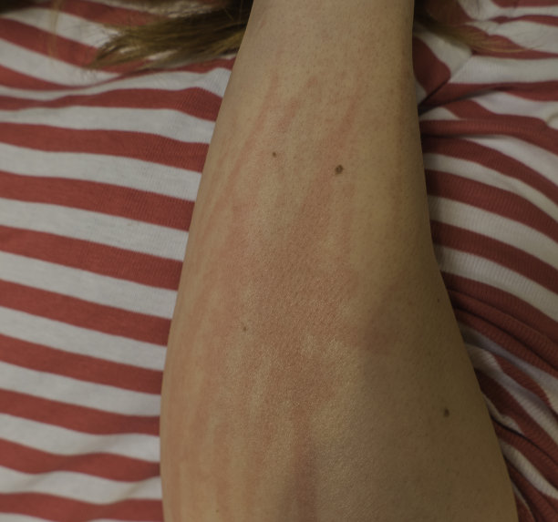 nettles