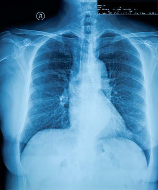 胸腔,X光片,医学扫描