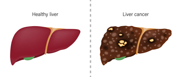 什么是病毒性肝炎