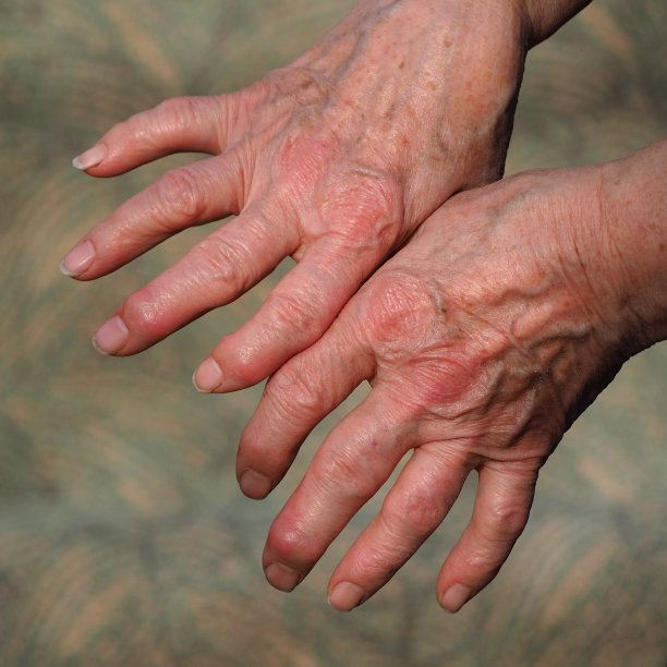 arthritis